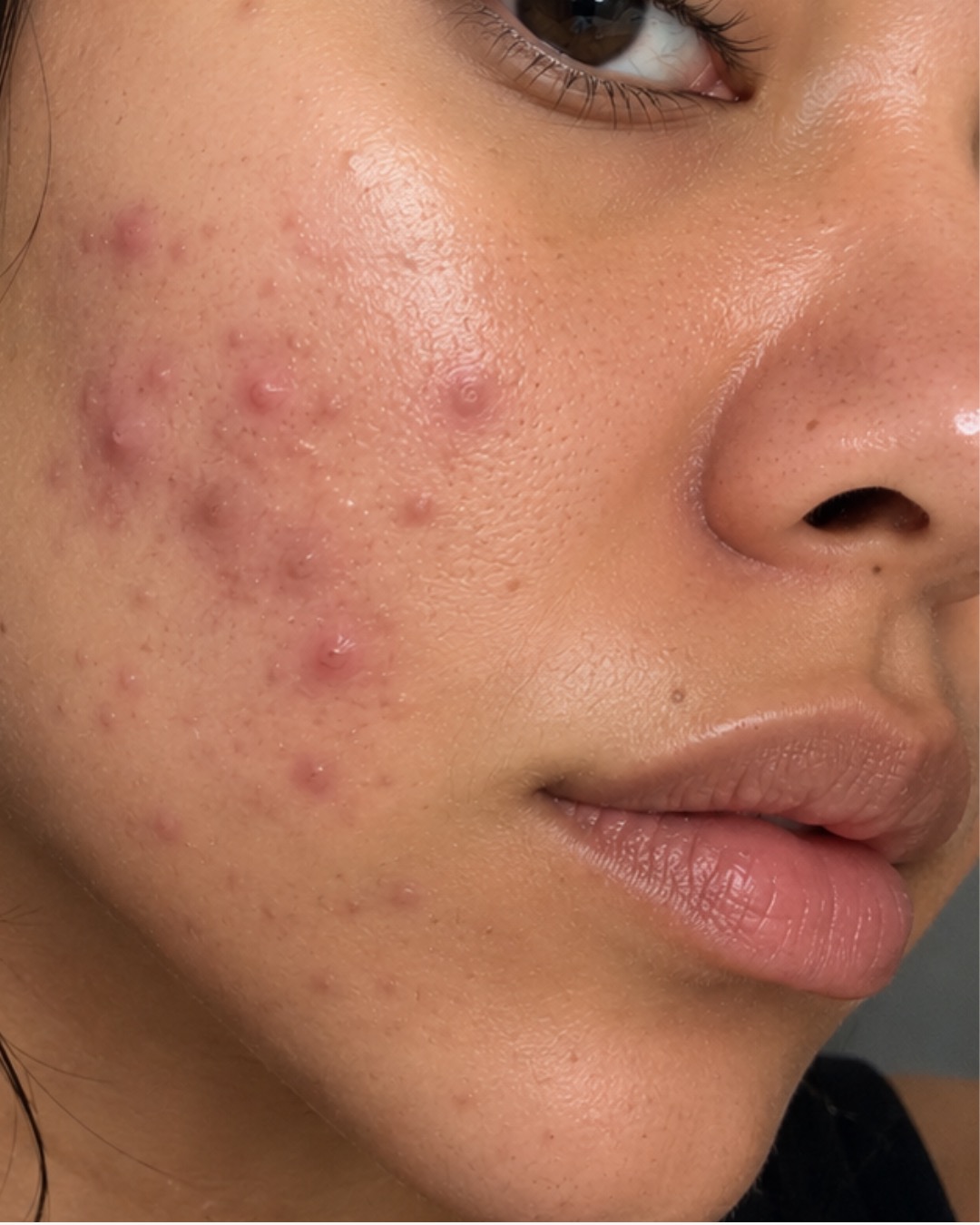 Acne & Congestion skin concern